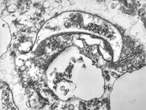 M,50y. | Pneumocystis carinii